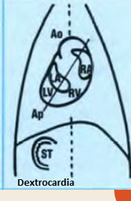 <p>Dextrocardia</p>