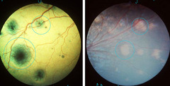 <p>Seeing things like this on a fundic exam is more typical of *bacterial or viral or fungal* disease.</p>