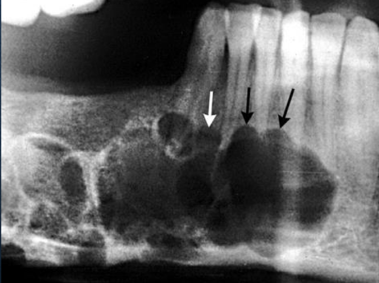 <p>what shape is this lesion?</p>