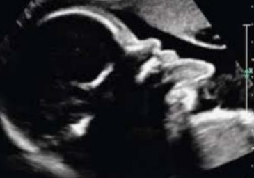 <p>What is being depicted in this image?</p><p>a. Proboscis</p><p>b. Macroglossia</p><p>c. Absent nasal bone</p><p>d. Cleft palate</p>