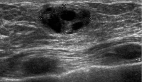 <p>SONO: Galactocele</p>