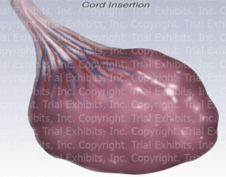 <p>type of placenta?</p>