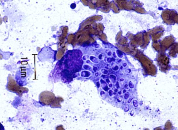 <p>blood &amp; bone marrow specimens. used to look for histoplasma capsulatum, an intracellular organism that appears as small oval to pear-shaped yeast-like cells </p>