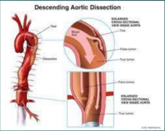 <p>tear in the wall of the vessel creates false lumen </p><p>- caused by HTN</p><p>- presents with terrible chest pain </p><p>- treat with surgery</p>