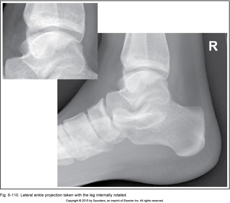 <p>lateral ankle</p>