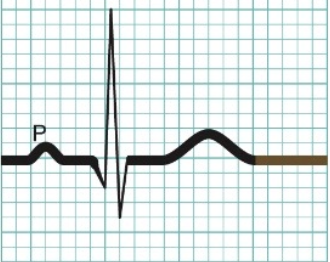 <p>Ventricular diastole (relaxation)</p>