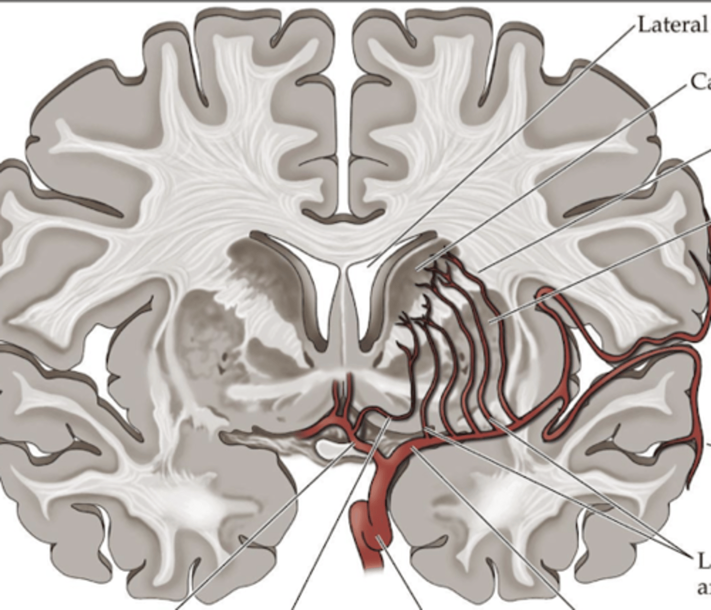 <p>The Internal Capsule, where ischemic strokes can lead to significant motor and sensory deficits.</p>
