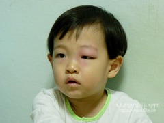 <p>sưng</p>