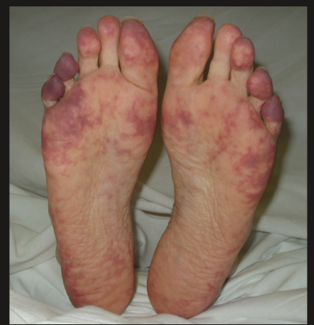 <p>tissue necrosis/gangrene, purple toe syndrome</p>
