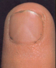 <p>AD at LMX1B. Eye issues (glaucoma, nystagmus), absent or deformed fingernails/toenails, patellar absence / malformation / frequent dislocation, abnormalities of the hip and pelvis bones. Pathognomic features: iliac horns (asymptomatic), triangular lunulae</p>