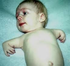 <p>AD at TBX5. Congenital heart defect (ASD, VSD), skeletal defects. upper limb and shoulder girdle malformation, thumb defects: triphalangeal (finger-like) thumb, absent thumb, extra carpal bones, bone protrusions</p>