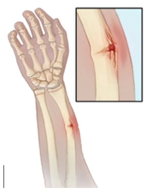 <p>incomplete fracture, usually at the radius</p><ul><li><p>more proximal than colles fractures</p></li><li><p>common to children due to soft, flexible bones</p></li></ul><p></p>