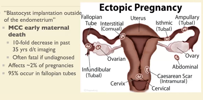 <p><u>Definition</u>: Blastocyst implantation outside of the endometrium</p><ul><li><p>MCC early maternal death (10 fold decrease in last 35 yers d/t imaging)</p></li><li><p>~2% of pregnancies, 95% in fallopian tube</p></li></ul><p><u>Risk factors</u></p><ul><li><p>Previous ectopic pregnancy (top risk factor), previous tubal surgery, Hx of infertility, endometriosis, PID (Hx of STD ie chalmydia), smoking (decrease motility), age</p></li></ul><p><u>Clinical presentation</u></p><ul><li><p>Early preg. Sxs less common due to lower hormone levels</p></li><li><p>Suspect in reproductive age w vaginal bleeding and/or pain</p><ul><li><p>No confirmed intrauterine preg, amenorrhea > 4 weeks</p></li><li><p>Hx of conception with IVF</p></li><li><p>Hemodynamically unstable w acute abdomen, no obvious source</p></li></ul></li></ul><p><u>DDx</u>:</p><ul><li><p>Normal pregnancy (implantation bleeding)</p></li><li><p>Abortion (threatened, inevitable, complete)</p></li><li><p>Cervical, vaginal, uterine (laceration, infection ,polyps, subchorionic hematoma)</p></li><li><p>Gestational trophoblastic disease (associated with high bHCG)</p></li><li><p>Other ie UTI, nephrolithiasis, appendicitis, ovarian pathology/mass, round ligament pain</p></li></ul><p><u>Diagnosis</u></p><ul><li><p>Transvaginal ultrasound more sensitive than transabdominal</p><ul><li><p>No intrauterine preg and ring of fire</p></li><li><p>Extrauterine gestational sac, adnexal mass</p></li><li><p>intraperitoneal bleeding (free fluid, coagulates)</p></li><li><p>Gold standard —→ Dx with laparoscopy</p></li></ul></li><li><p>Rare —> heterotopic pregnancy (both intrauterine and one ectopic)</p></li><li><p>US and HcG levels used for diagnosis</p><ul><li><p>Transvaginal 1500-2000 HcG should be seen with IUP</p></li><li><p>Transabdominal above 5000 HcG should be seen on IUP</p></li><li><p>bHcG should double q48hours (if pt is stable and preg is unknown location) —> then can repeat ultrasound (ie 1500 on Monday should be 3000 on Wednesday)</p></li></ul></li></ul><p><u>Management</u></p><ul><li><p>Methotrexate</p><ul><li><p>Inhibits folate synthesis (stop prenatal vitamins), multiple dosaging regimens, Follow <strong>LFTs, bHCG until zero,</strong> reverse w leucovorin</p></li><li><p>Indications: Asymptomatic compliant pt (needs to follow up for HCG labs), bHCG < 5000, unruptured sac, no fetal cardiac activity, size < 4cm</p></li></ul></li><li><p>Surgical</p><ul><li><p>Indications: non compliant ( no f/u), hemodynamically unstable, desires surgery</p></li></ul><ul><li><p>Laparoscopy vs laparotomy</p><ul><li><p>Depends on hemodynamic factors, possible to preserve fertility w salpingostomy</p></li></ul></li></ul></li></ul><p><u>Follow up</u></p><ul><li><p>More likely to have another one now, resolution of preg needs to be confirmed w neg preg test (before becoming preg again), counsel on future preg and offer BC if no desire to become preg in future</p></li></ul><p></p>