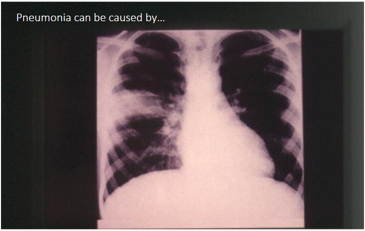 <p>Pneumonia can be caused by</p>
