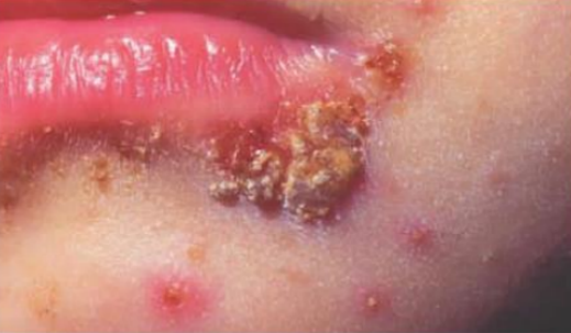 <p>superficial cutaneous infection commonly seen in newborns and young children characterized by the formation of encrusted pustules surrounded by red border</p>