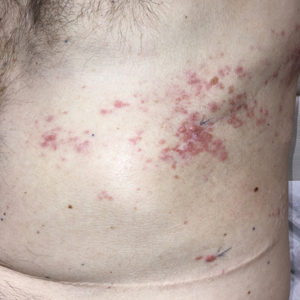 <p>Shingles </p>