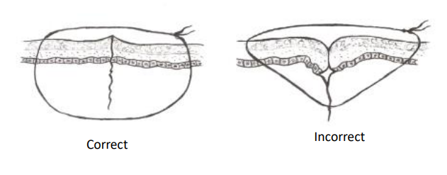 <p>Correct = eversion</p><ul><li><p>enter skin at 90 degree angle</p></li><li><p>wound edges should slightly evert </p></li></ul><p></p>