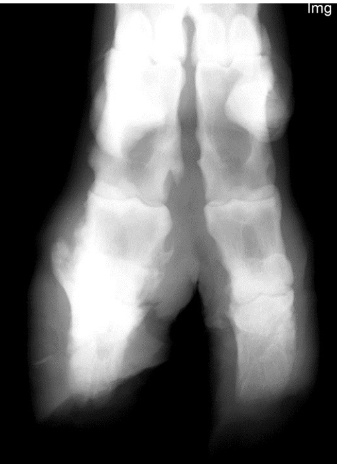 <p>Pedal osteitis</p>