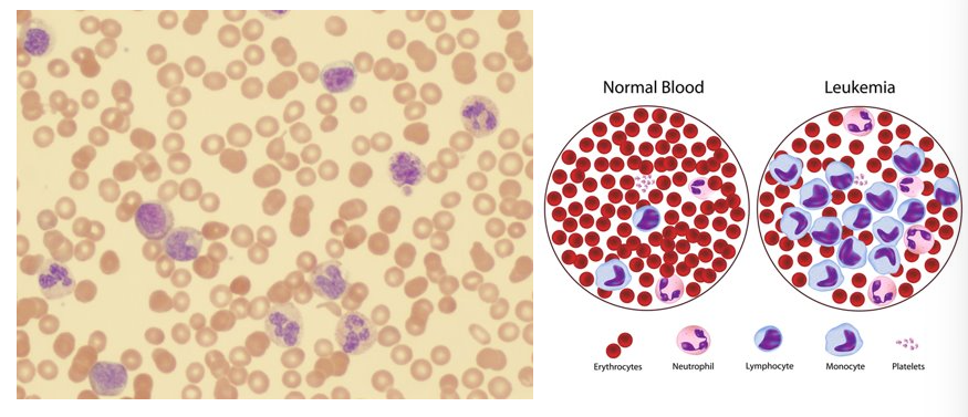 <p>type of blood cancer; high levels of abnormal leukocytes (WBCs)</p>
