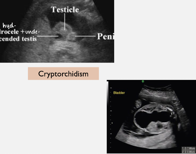 <ul><li><p>hypoplastic/absent anterior abdominal muscles</p></li><li><p>protrusion of anterior abdominal wall</p></li><li><p>massively distended bladder</p></li><li><p>dilated, tortuous ureters</p></li><li><p>cryptorchidism</p></li><li><p>dilated prostatic urethra</p></li><li><p>kidneys may be normal, hydronephrotic, or dysplastic </p></li></ul><p></p>