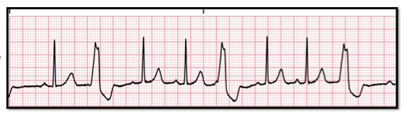 <p>Identify the above waveform:</p><p>a. Paired PVCs</p><p>b. Trigeminy</p><p>c. Bigeminy</p><p>d. PAC (premature atrial contraction)</p>