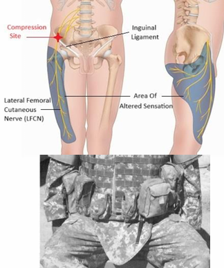 <p><span style="color: red;"><strong>Lateral Femoral Cutaneous Nerve </strong></span>(Meralgia Paresthetica)</p>