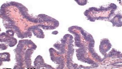 <p>What type of DCIS?</p>