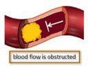 <p>Blocked blood flow deprives brain of oxygen.</p>