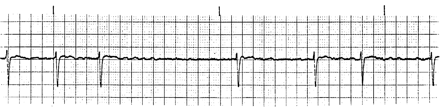 <p>What ECG is this? </p>