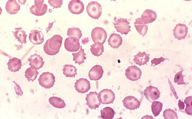 <p>what hemoglobinopathy is this?</p>