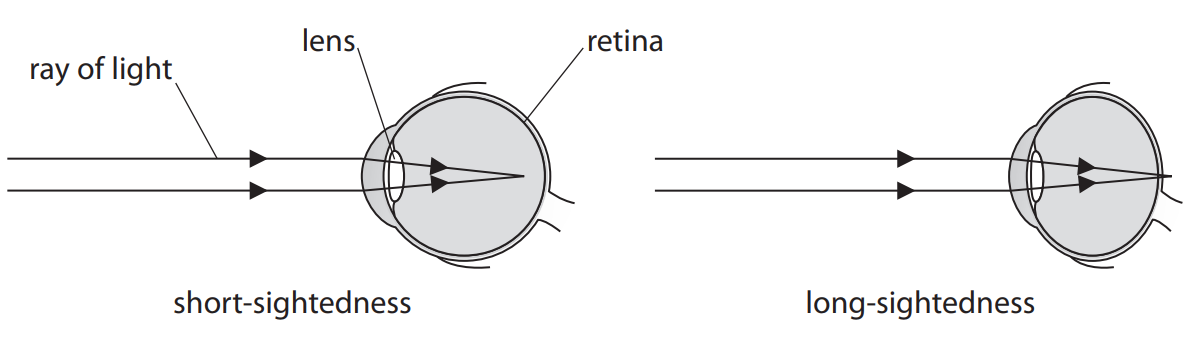 <p>Explain the causes of short-sightedness. (3) </p>