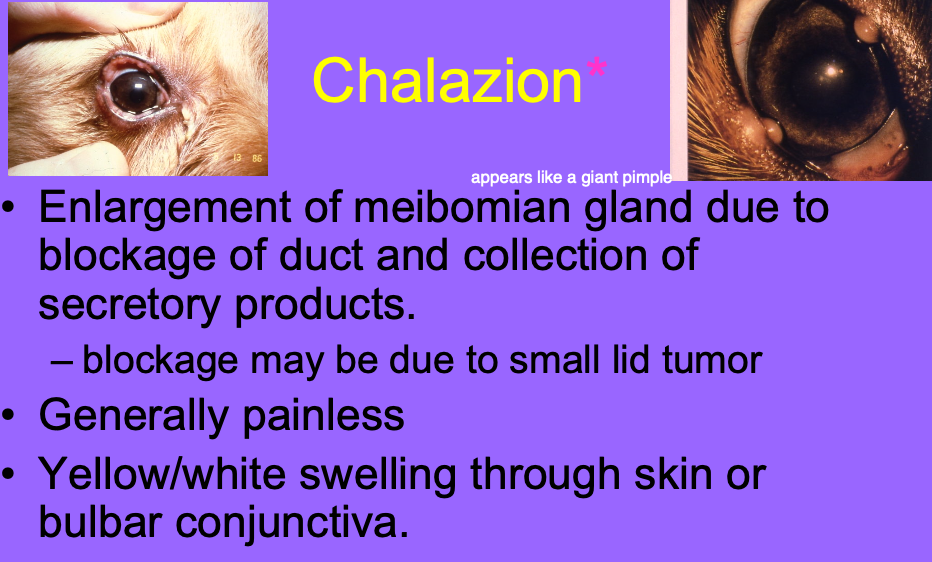 <p>painless. yellow/white swelling through skin or bulbar conjunctiva.</p>