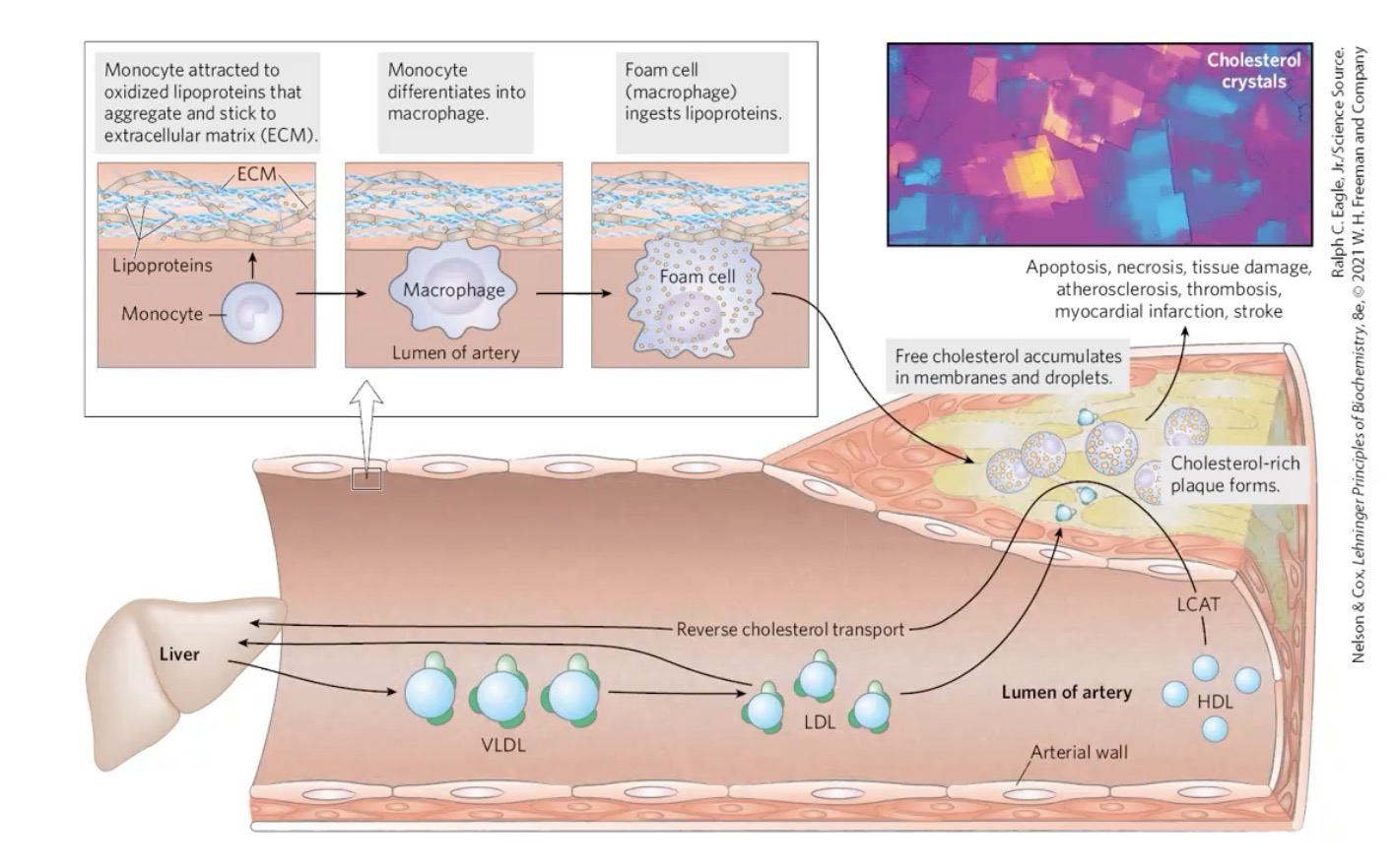 <p>Plaque; Leads to occluded artery; LDL concentration increases in blood, enters space between endothelial and smooth muscle cells. undergoes oxidation.</p><p>Can be cleared if a monocyte recognizes area, differentiates into mocophage and engulfs lipoproteins, turning the monocyte into a foam cell. This can then be cleared by HDL.</p><p>If clearance does not occur, plaque accumulates and occludes artery </p><p></p>