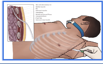 <p><span style="background-color: transparent;"><strong>Thoracotomy parts</strong></span></p>