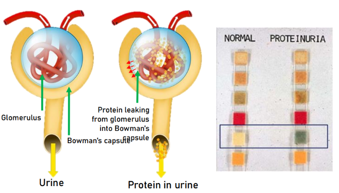 <p>Protein in the urine due to disruption of the filtration barrier</p><ul><li><p>Diabetes mellitus - excessive plasma glucose damages filter</p></li><li><p>Hypertension - high glomerular hydrostatic pressure damages filter</p></li><li><p>Glomerulonephritis - inflammatory damage due to immunological attack</p></li></ul><p></p>