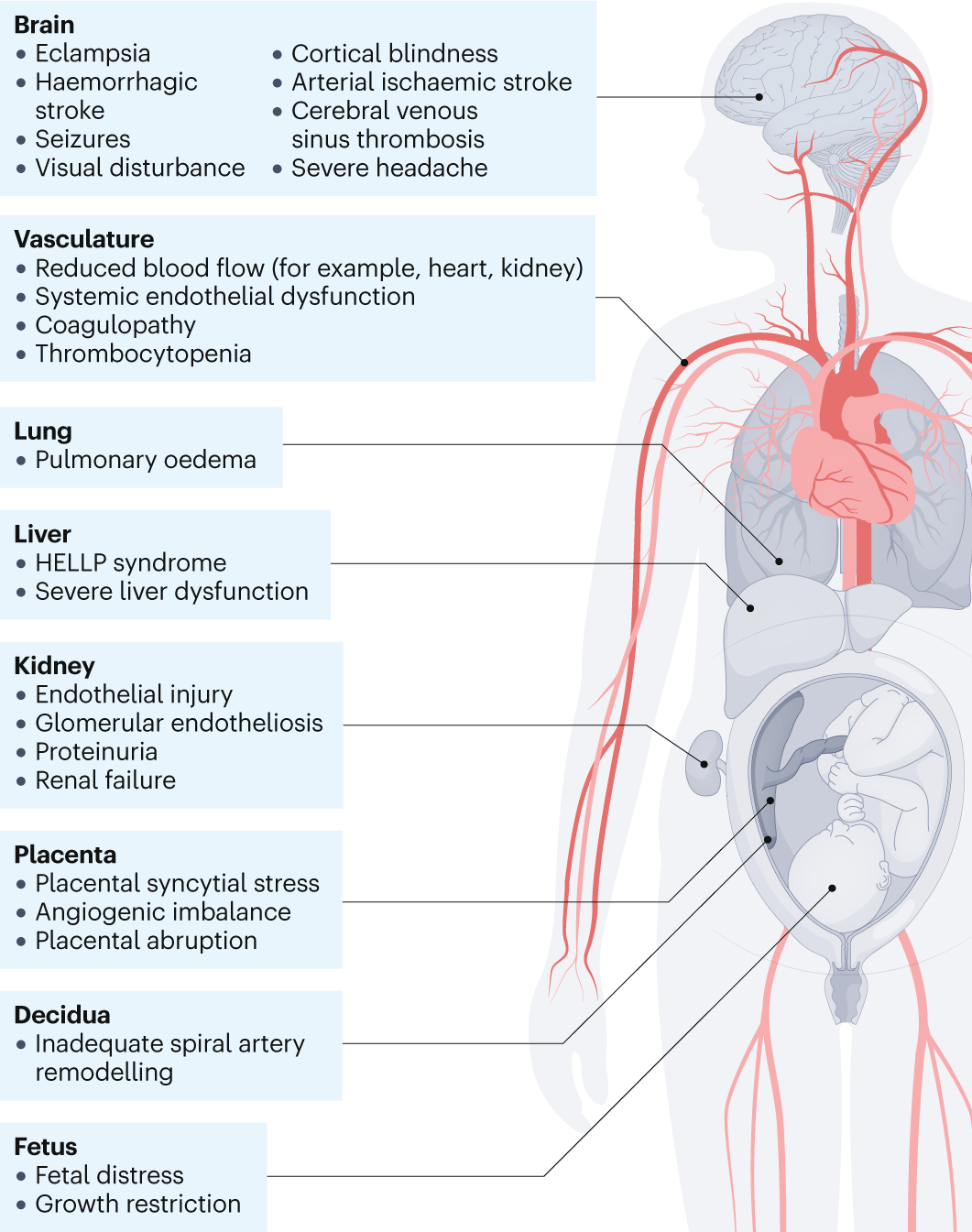 <p>A pregnancy complication characterized by high blood pressure (140/90) and signs of damage to other organ systems, often the kidneys (proteinuria), typically occurring after the 20th week of gestation. </p>