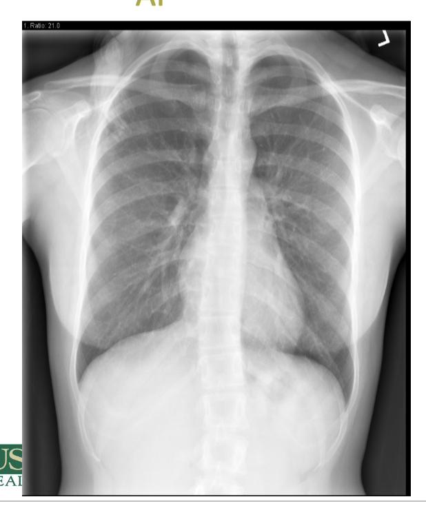 <p>which type of projection is attached? </p>