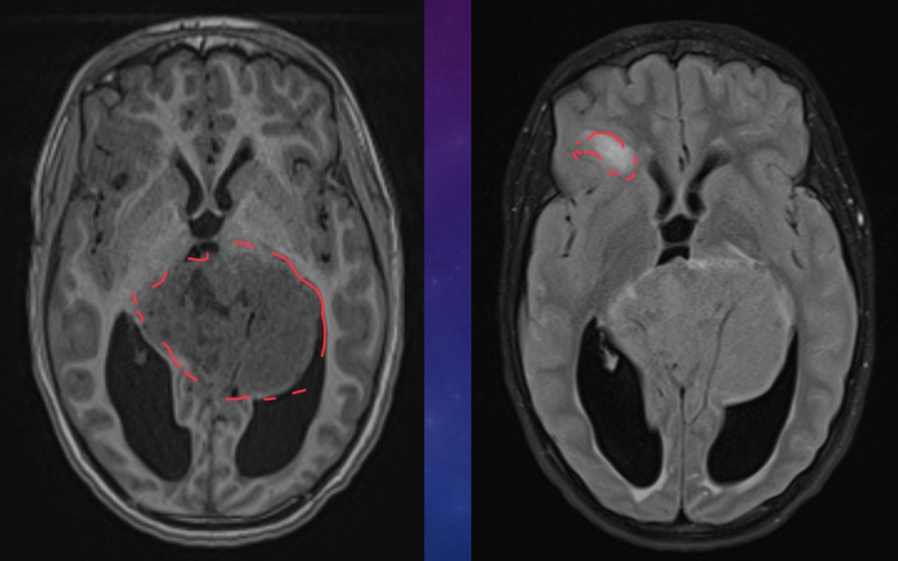 <p>10-year-old male has a history of intermittent headaches for the past five months.</p>