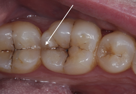 <p>What is a cracked tooth?</p>