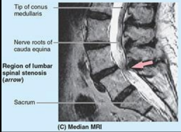 <p>narrowing of the spinal canal in the lumbar region, puts pressure on the nerves below it.</p>
