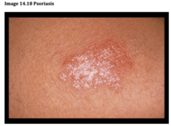 <p>Keratotic pruritic plaques, usually extensor surfaces and trunk</p>