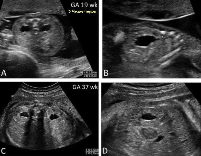 <p><span style="color: yellow;">>4mm </span>= hydro</p><p></p>