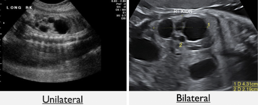 <p><strong>unilateral</strong></p><ul><li><p>multiple, smooth-walled cysts of varying sizes</p></li><li><p>cysts do not communicate with each other</p></li><li><p>normal appearing contralateral kidney</p></li><li><p>bladder is visible</p></li><li><p>normal AFI</p></li></ul><p><strong>bilateral</strong></p><ul><li><p>multiple, noncommunicating renal cysts within both kidneys</p></li><li><p>failure to visualize bladder</p></li><li><p>severe oligohydramnios</p></li></ul><p></p>
