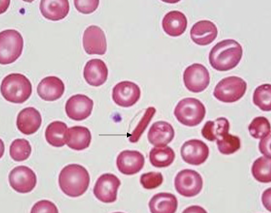 <p>name the type of RBC inclusion</p>