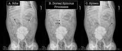 <p>What is the best anatomic structure to use to determine whether or not the patient is rotated?</p>