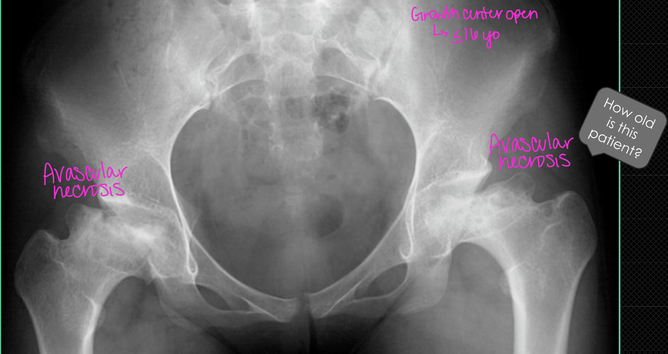 <p>SLE + increased risk of clots + Tx of corticosteroids = </p>