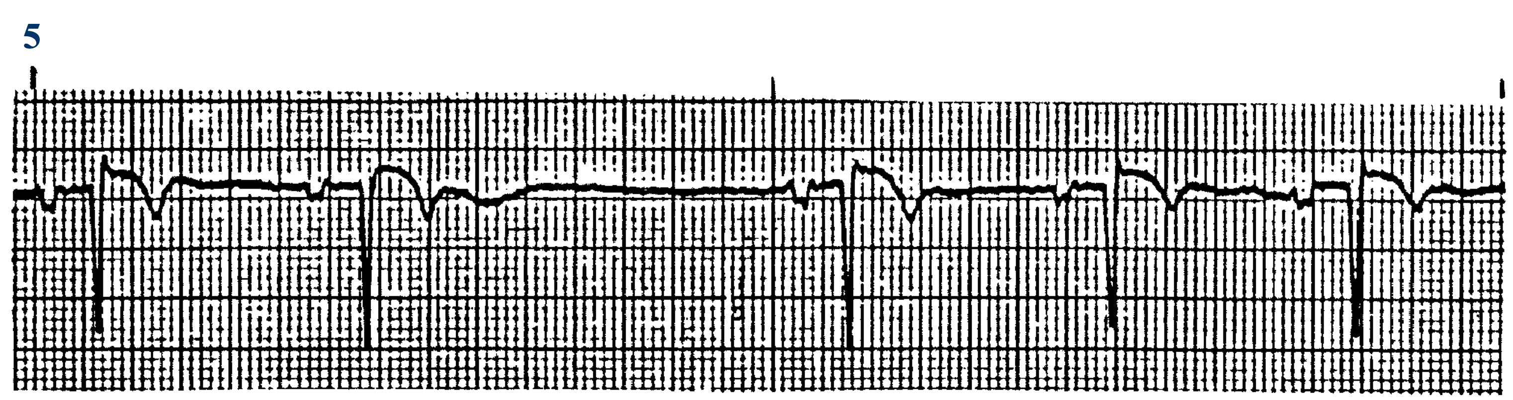 <p>What ECG is this? </p>