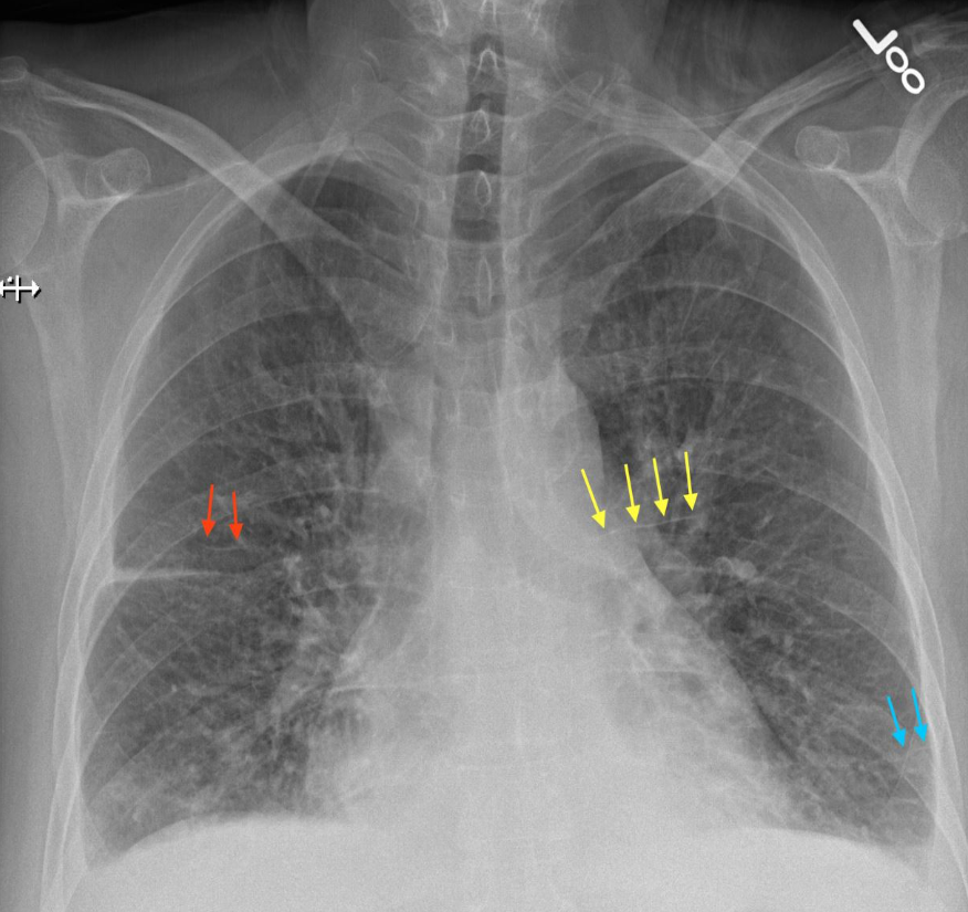 <p>what abnormality is highlighted by the blue lines in this image</p>