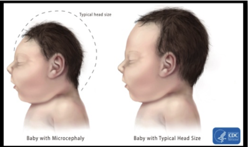 <p><span style="background-color: transparent;"><strong>&nbsp;Does microcephaly have a vector? If so, Identify the vector.</strong></span></p>