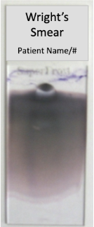 <p><span style="background-color: transparent;"><u>Principle of Romanowsky-type stains</u></span></p><ul><li><p><span style="background-color: transparent;">Well-made smears are essential to the evaluation of hematologic disorders</span></p></li><li><p><span style="background-color: transparent;">These are pH-dependent reactions</span></p></li></ul><p><span style="background-color: transparent;"><u>Action of the reagents/dyes</u></span></p><p><span style="background-color: transparent;"><strong>Methylene blue</strong></span></p><ul><li><p><span style="background-color: transparent;">Stains acid cell structures a blue color</span></p></li><li><p><span style="background-color: transparent;">RNA in cytoplasm, basophil granules</span></p></li></ul><p><span style="background-color: transparent;"><strong>Eosin</strong></span></p><ul><li><p><span style="background-color: transparent;">Stains basic cell structures a red-orange color</span></p></li><li><p><span style="background-color: transparent;">Hgb in RBCs, eosinophil granules</span></p></li></ul><p><span style="background-color: transparent;"><strong>Combo of Both Dyes</strong></span></p><ul><li><p><span style="background-color: transparent;">Stains neutral cell structures a pinkish-tan color</span></p></li><li><p><span style="background-color: transparent;">Neutrophil granules</span></p></li></ul><p><span style="background-color: transparent;"><u>Characteristics of a properly made smear</u></span></p><ul><li><p><span style="background-color: transparent;">Proper length</span></p></li><li><p><span style="background-color: transparent;">Proper width</span></p></li><li><p><span style="background-color: transparent;">Proper thickness</span></p></li><li><p><span style="background-color: transparent;">Presence of squared feathered edge with rainbow area</span></p></li><li><p><span style="background-color: transparent;">Angle of pusher and/or size of blood drop is critical and determines length and thickness</span></p></li></ul><p></p>